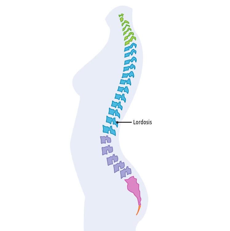 Lordosis of the spine