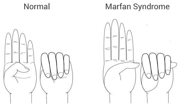 Marfan Syndrome hands