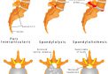 Care, spondylolistesis faq-1