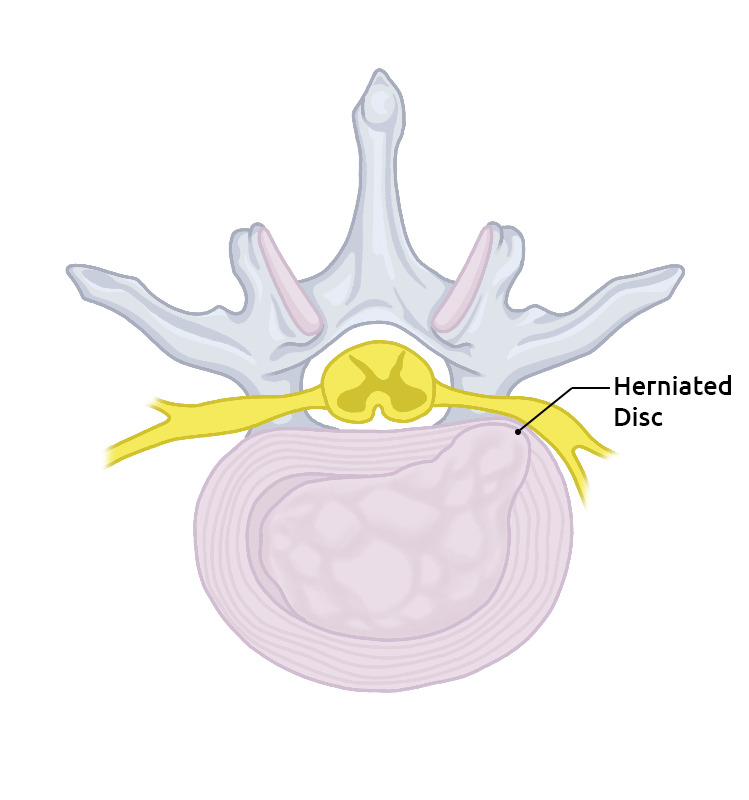 Herniated disc definition
