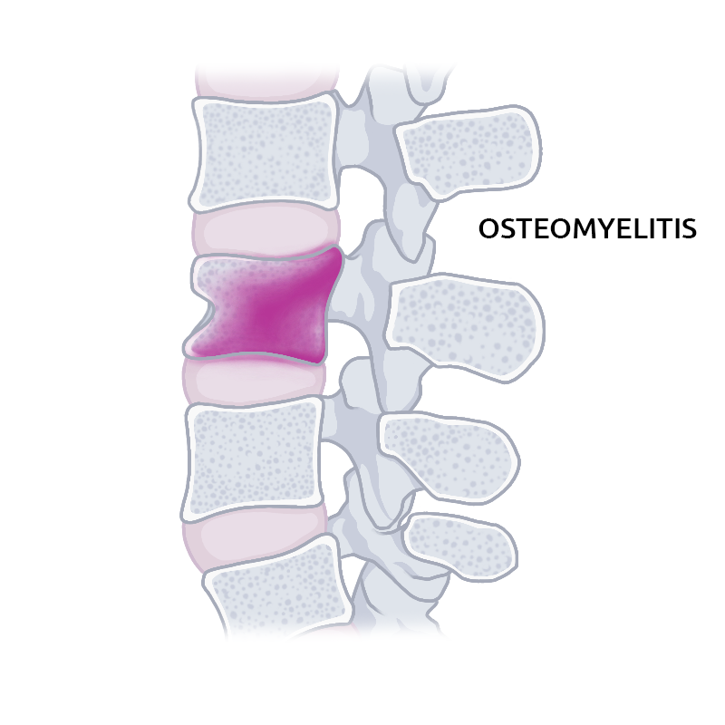 Osteomyelitis definition
