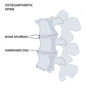 Arthritis of the spine