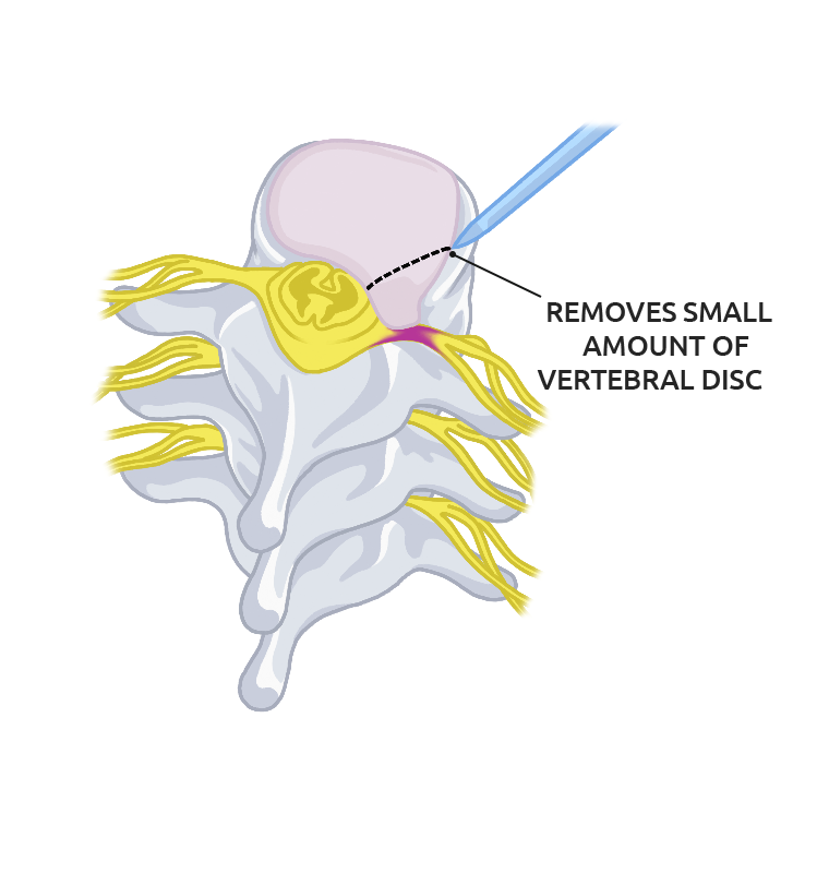 Herniated disc pain relief