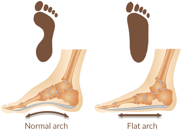 Flat feet