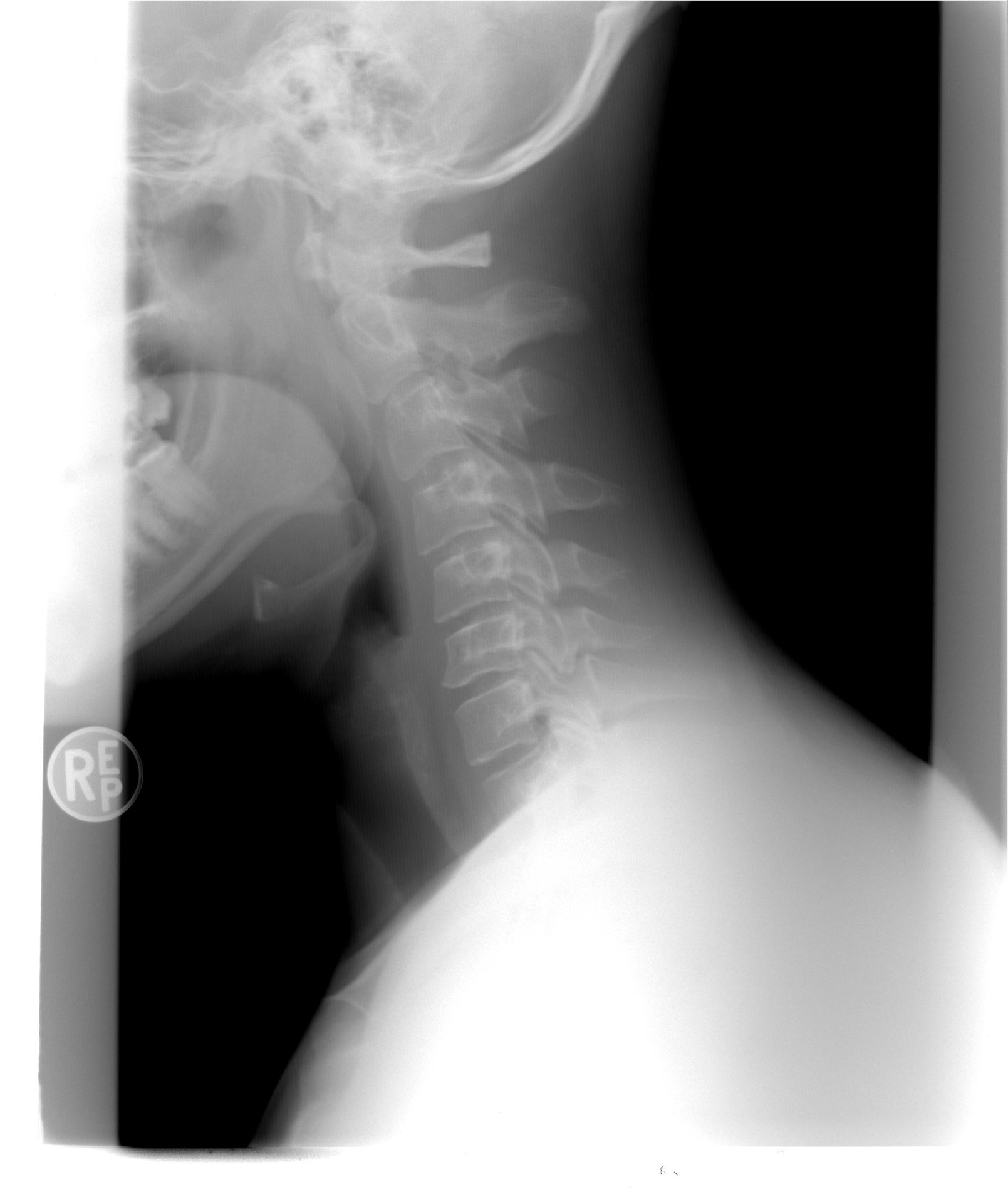 Spinal stenosis X-ray